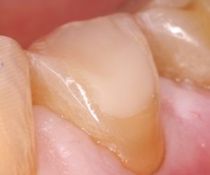 repaired dental erosion